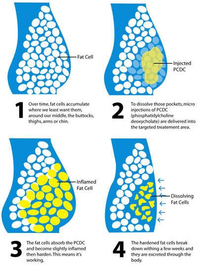 Lipo Dissolve Or Pcdc Injections Elite Body Contour Wellness